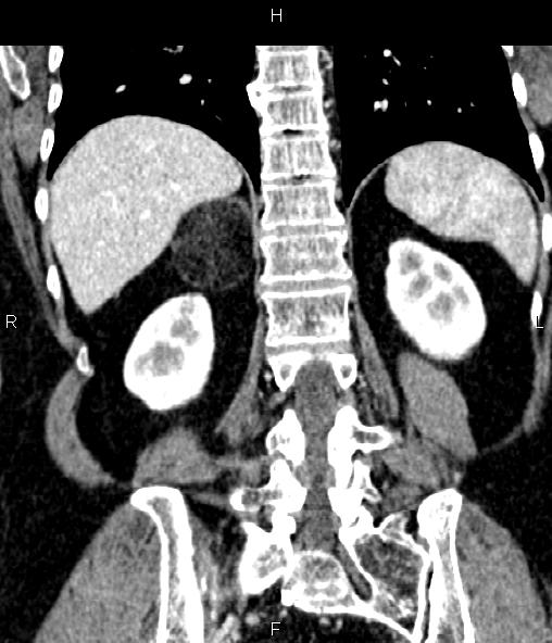 Adrenal myelolipoma (Radiopaedia 82742-96986 Coronal renal cortical phase 55).jpg