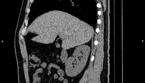 Adrenal myelolipoma (Radiopaedia 84321-99619 Sagittal non-contrast 33).jpg