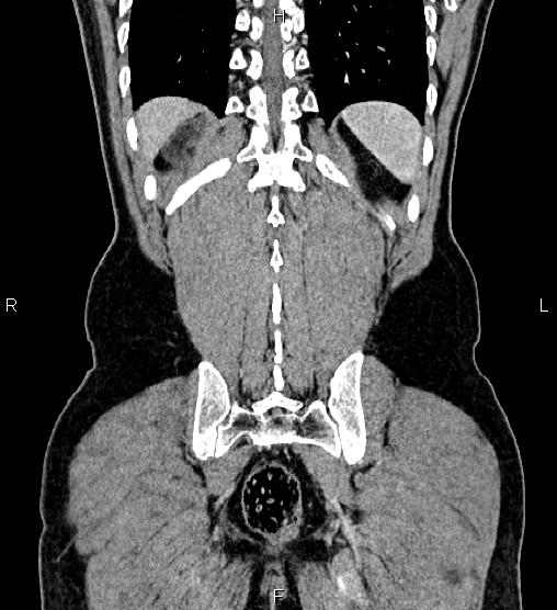 Adrenal myelolipoma (Radiopaedia 87794-104246 Coronal renal cortical phase 56).jpg