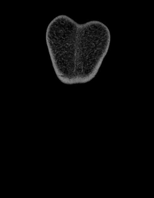Adrenal myelolipoma - bilateral (Radiopaedia 74805-85810 Coronal C+ portal venous phase 273).jpg