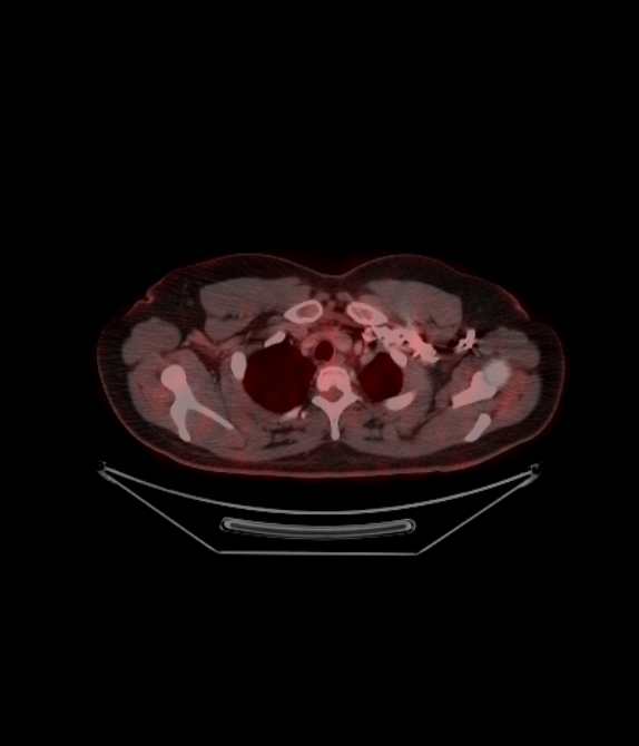 Adrenocortical carcinoma (Radiopaedia 80134-93440 ِAxial 90).jpg