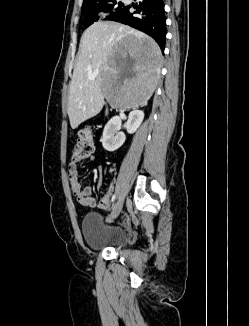 Adrenocortical carcinoma (Radiopaedia 87281-103569 Sagittal C+ portal venous phase 98).jpg