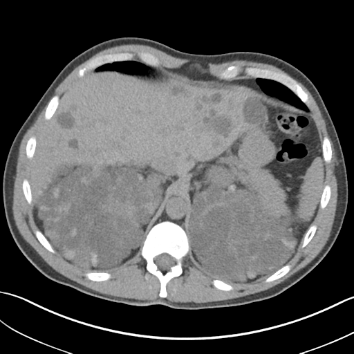 File:Adult polycystic kidney disease (Radiopaedia 47866-52626 Axial non-contrast 15).png