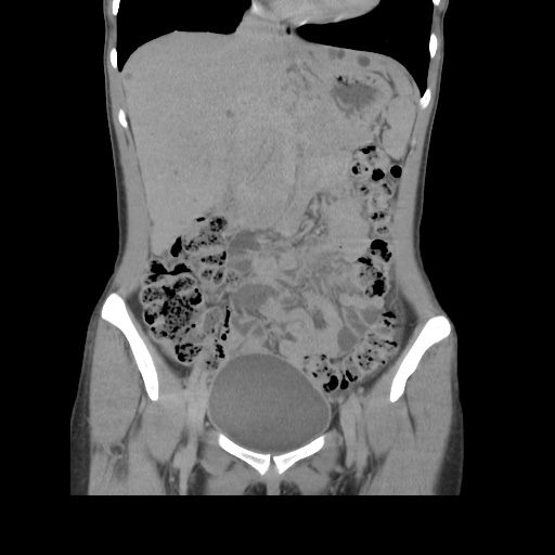 File:Adult polycystic kidney disease (Radiopaedia 48845-53876 Coronal renal excretory phase 16).jpg