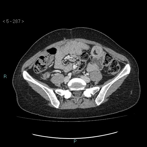 Adult transient intestinal intussusception (Radiopaedia 34853-36310 Axial C+ portal venous phase 66).jpg