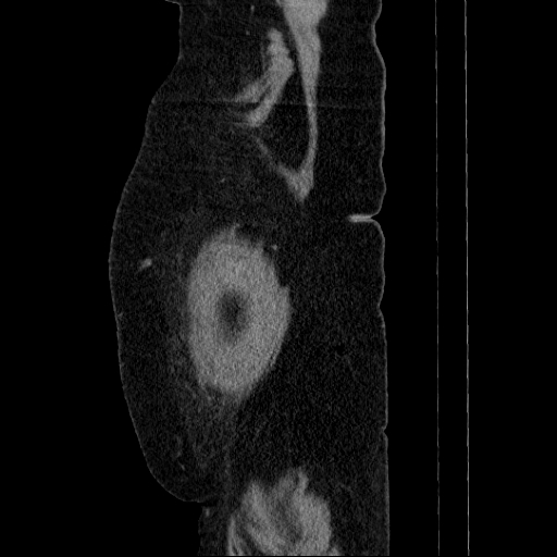 File:Afferent loop syndrome - secondary to incarcerated trocar site hernia (Radiopaedia 82959-97305 Sagittal C+ portal venous phase 4).jpg