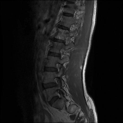 File:Aggressive vertebral hemangioma with pathological fracture (Radiopaedia 69528-79411 Sagittal T1 C+ 9).jpg