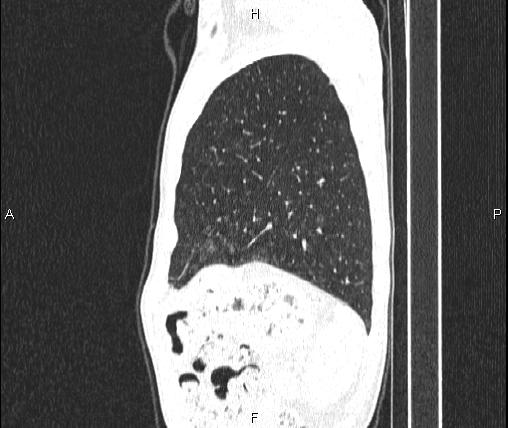 File:Air bronchogram in pneumonia (Radiopaedia 85719-101512 Sagittal lung window 85).jpg