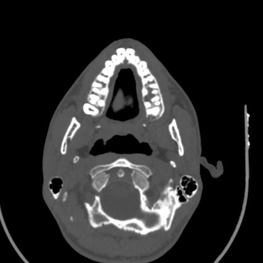 Allergic fungal sinusitis (Radiopaedia 88725-105456 Axial bone window 1).jpg