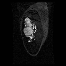Alveolar soft part sarcoma (Radiopaedia 64501-73678 D 119).jpg