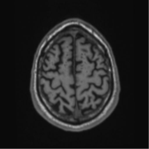 Alzheimer's disease- with Gerstmann syndrome and dressing apraxia (Radiopaedia 54882-61150 Axial T1 63).png