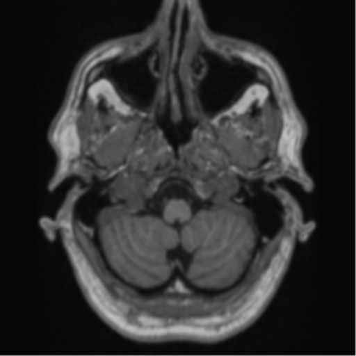 Alzheimer's disease- with Gerstmann syndrome and dressing apraxia (Radiopaedia 54882-61150 Axial T1 9).png
