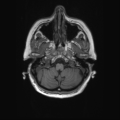 File:Alzheimer's disease (Radiopaedia 42658-45802 Axial T1 128).png