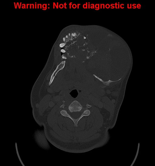 Ameloblastoma (Radiopaedia 33126-34164 Axial bone window 17).jpg