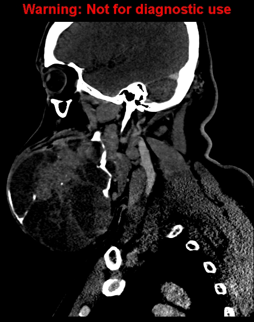 Ameloblastoma (Radiopaedia 33126-34164 F 23).jpg