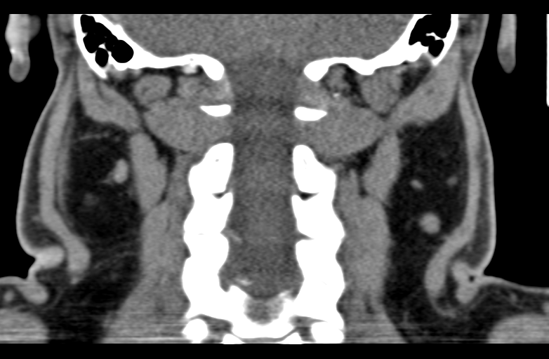 File:Ameloblastoma (Radiopaedia 33677-34806 Coronal non-contrast 53).png