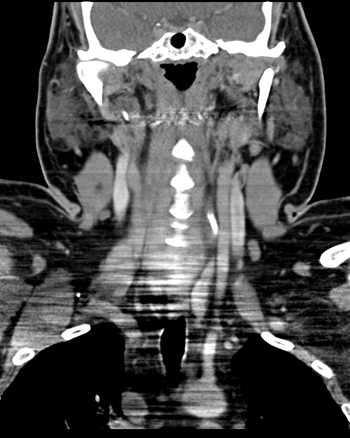 Ameloblastoma (Radiopaedia 38520-40623 Coronal non-contrast 41).png