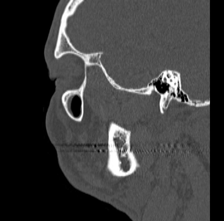 Ameloblastoma (Radiopaedia 77750-89997 Sagittal bone window 88).jpg