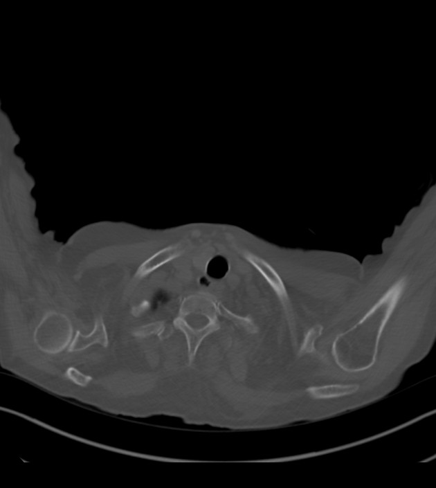 Amiodarone deposition in the liver (Radiopaedia 77587-89780 Axial bone window 5).jpg