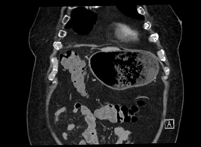 Ampullary adenocarcinoma (Radiopaedia 59373-66737 B 16).jpg