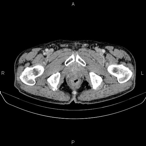 Ampullary adenocarcinoma (Radiopaedia 86093-102032 A 58).jpg