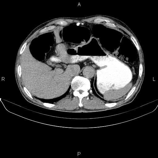 File:Ampullary adenocarcinoma (Radiopaedia 86093-102032 Axial C+ delayed 21).jpg