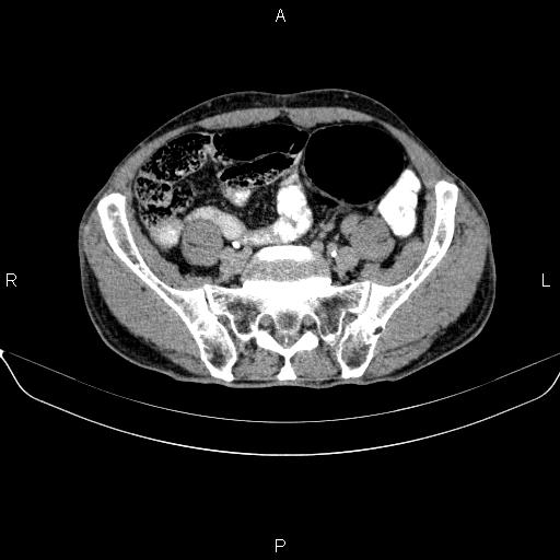 Ampullary adenocarcinoma (Radiopaedia 86093-102032 Axial C+ delayed 79).jpg