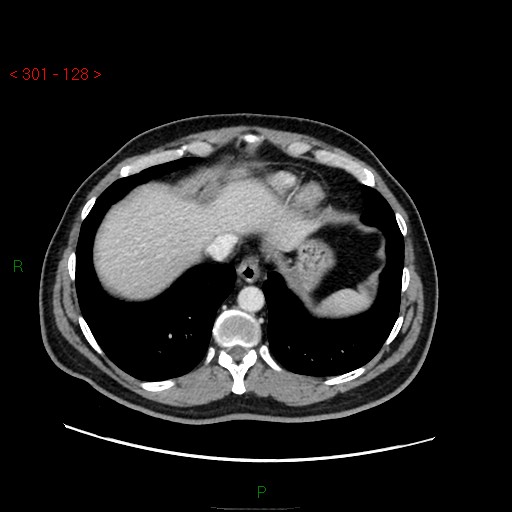 Ampullary carcinoma (Radiopaedia 56396-63056 C 13).jpg