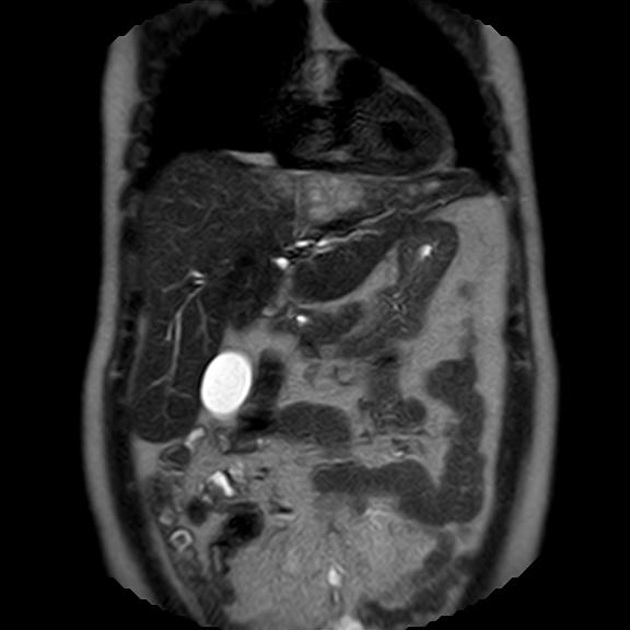 File:Ampullary tumor (Radiopaedia 27294-27479 Coronal T2 7).jpg