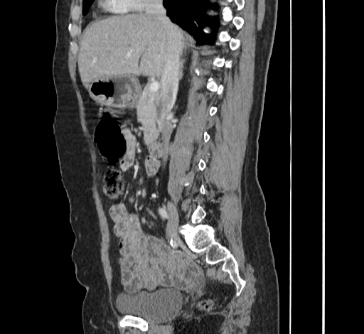 Ampullary tumor (Radiopaedia 60333-67998 C 24).jpg