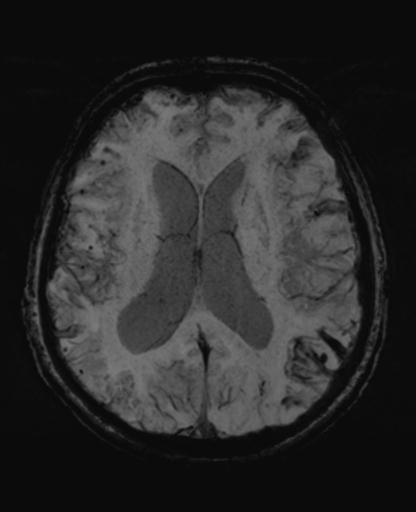 File:Amyloid angiopathy with inflammation (Radiopaedia 30360-31002 Axial SWI MIP 34).jpg