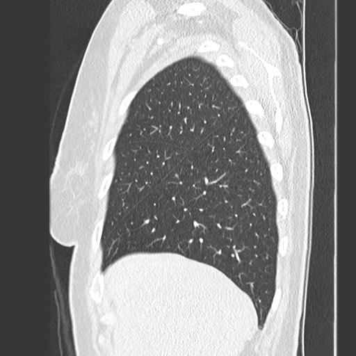 Amyloidosis - bronchial and diffuse nodular pulmonary involvement (Radiopaedia 60156-67745 Sagittal lung window 15).jpg