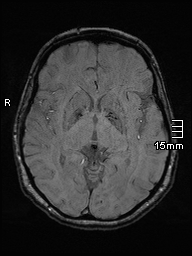 Amyotrophic lateral sclerosis (Radiopaedia 70821-81017 Axial SWI 24).jpg