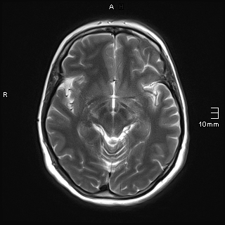 File:Amyotrophic lateral sclerosis (Radiopaedia 70821-81017 Axial T2 12).jpg