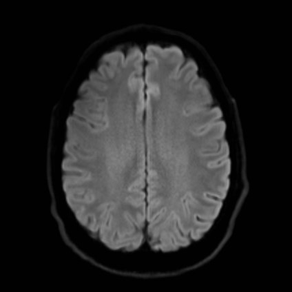 Amyotrophic lateral sclerosis (Radiopaedia 87352-103658 Axial DWI 47).jpg