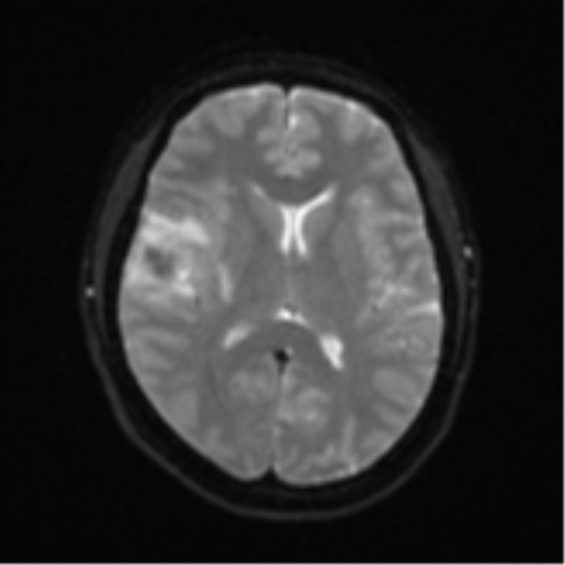 Anaplastic astroblastoma (Radiopaedia 55666-62194 Axial DWI 16).png