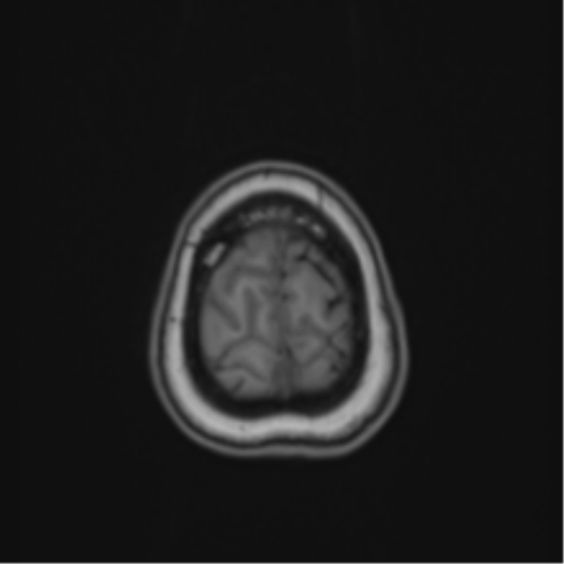 Anaplastic astroblastoma (Radiopaedia 55666-62194 Axial T1 69).png
