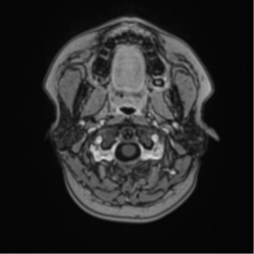 Anaplastic astroblastoma (Radiopaedia 55666-62194 Axial T1 C+ 2).png