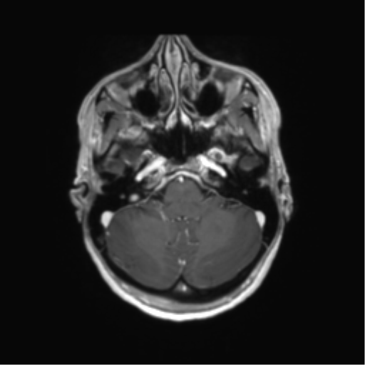 File:Anaplastic astrocytoma IDH mutant (Radiopaedia 50046-55341 Axial T1 C+ 12).png