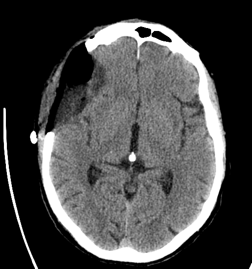 File:Anaplastic meningioma with recurrence (Radiopaedia 34452-35786 Axial non-contrast 16).png