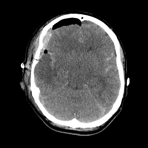 Aneursym related subarachnoid hemorrhage with hydrocephalus (Radiopaedia 45105-49085 Axial non-contrast 19).jpg