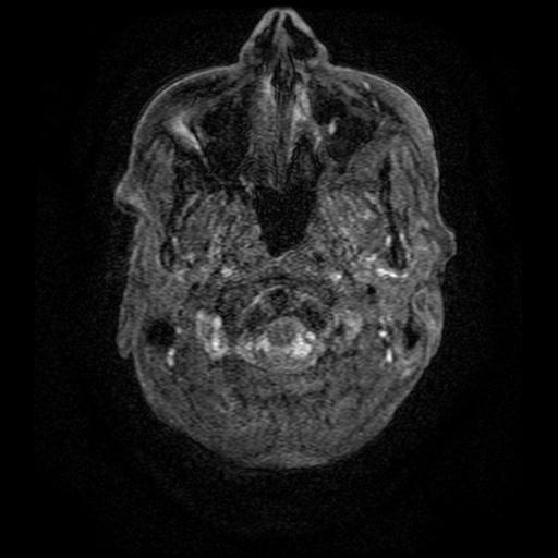 File:Aneurysm of the terminal internal carotid artery (Radiopaedia 88167-104764 H 1).jpg