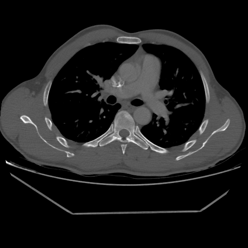 File:Aneurysmal bone cyst - rib (Radiopaedia 82167-96220 Axial bone window 121).jpg