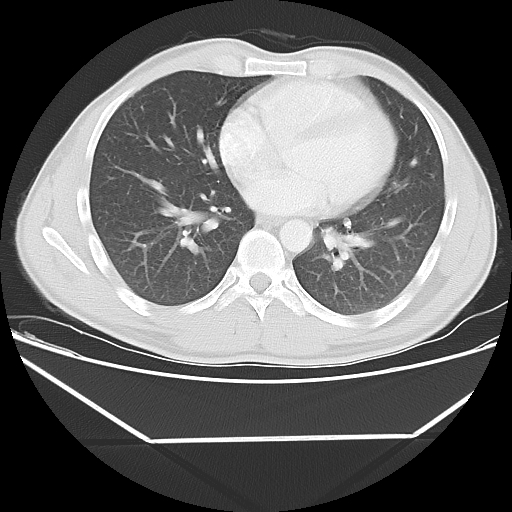 File:Aneurysmal bone cyst - rib (Radiopaedia 82167-96220 Axial lung window 41).jpg