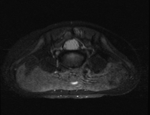 File:Aneurysmal bone cyst - sacrum (Radiopaedia 65190-74196 Axial T2 fat sat 2).jpg