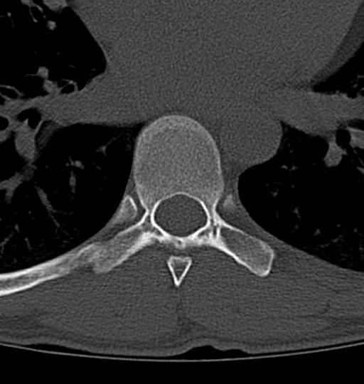 Aneurysmal bone cyst T11 (Radiopaedia 29294-29721 Axial bone window 12).jpg