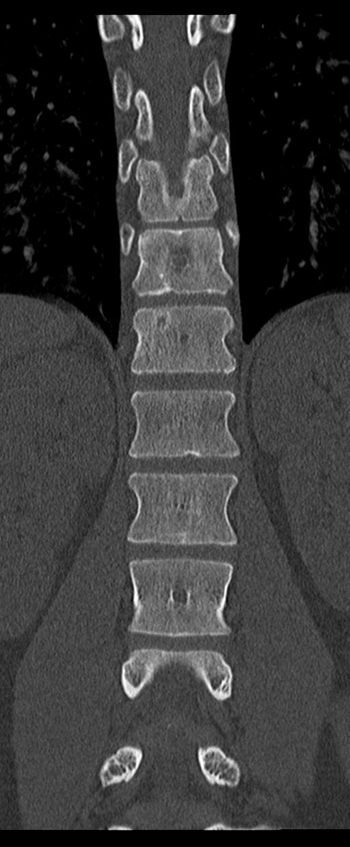 Aneurysmal bone cyst T11 (Radiopaedia 29294-29721 Coronal bone window 33).jpg