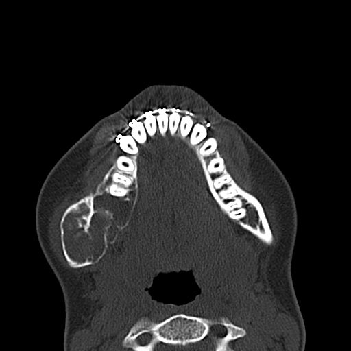 File:Aneurysmal bone cyst of the mandible (Radiopaedia 43280-46601 Axial bone window 24).jpg