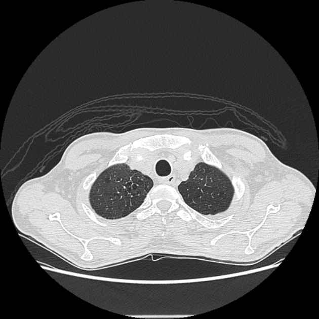 Angioinvasive aspergellosis (Radiopaedia 66995-76315 Axial lung window 4).jpg