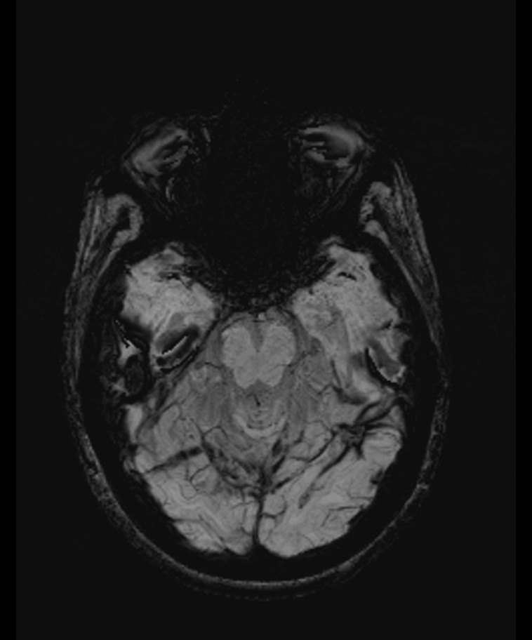 Angiomatous meningioma (Radiopaedia 79459-92579 E 21).jpg